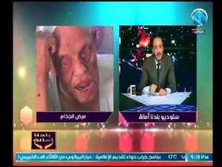 بالصور الكارثية (+18) .. خالد علوان يناشد الدولة بإبادة مستعمرة الجزام وعلاجها