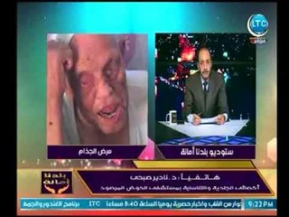 أخصائي جلدية يوضح أعراض المرض الجلدي الخطير (الجزام) وكيف نتعرف عليه في بدايته