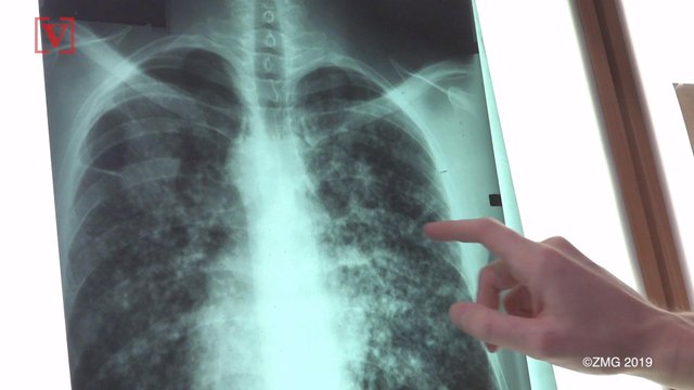 A Breathalyzer Capable Of Detecting Cancer Could Save Millions