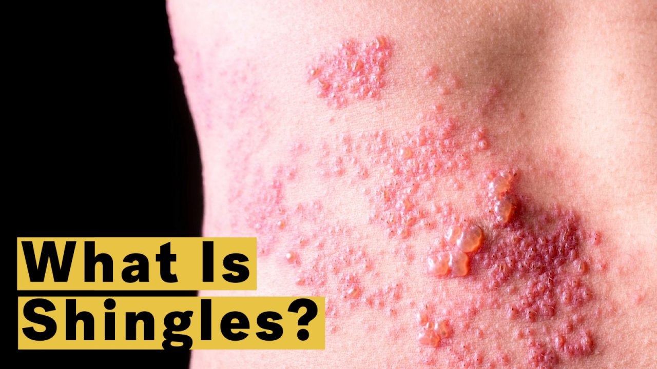 What Is Shingles?