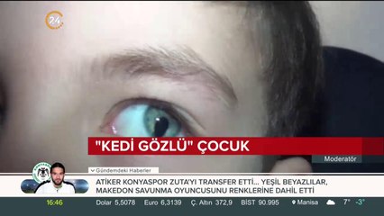 "Kedi gözlü" çocuk