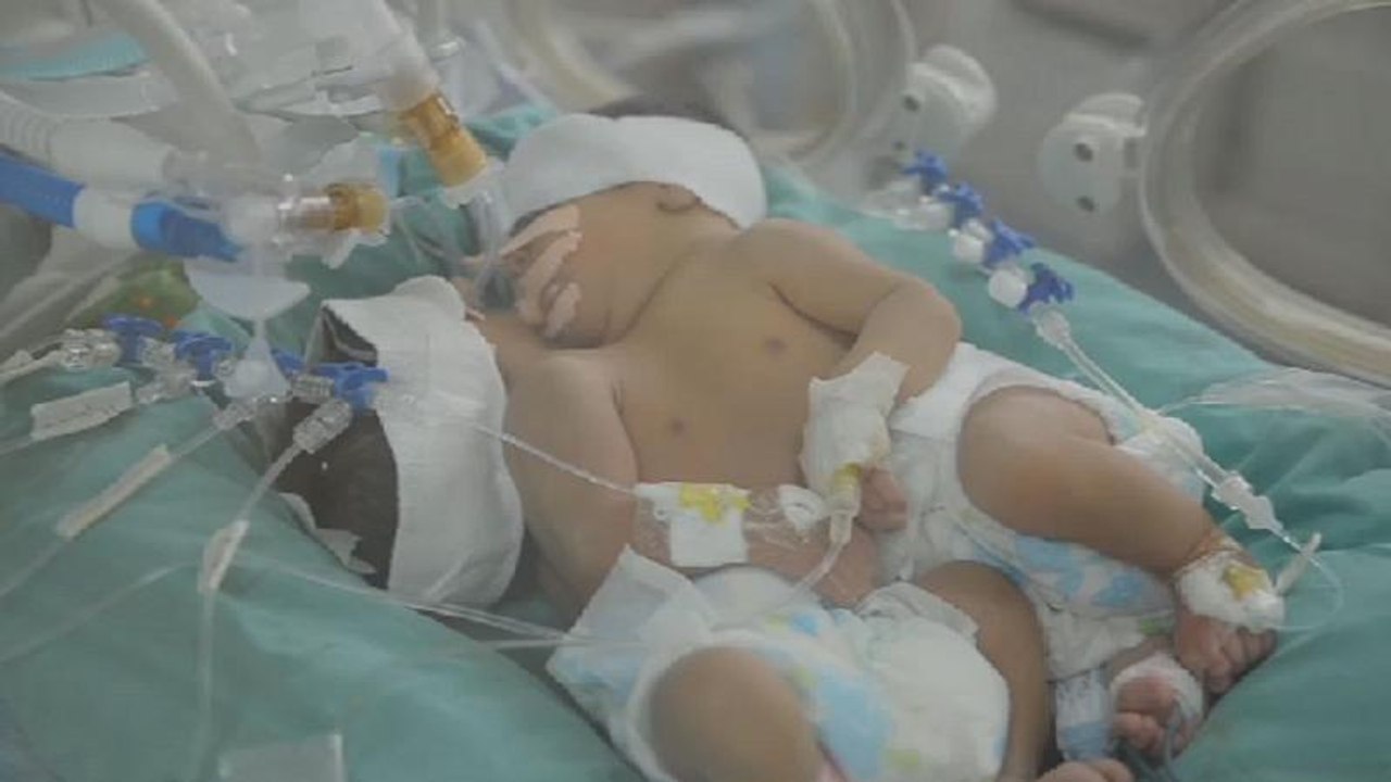 Mauritian couple give birth to siamese twins