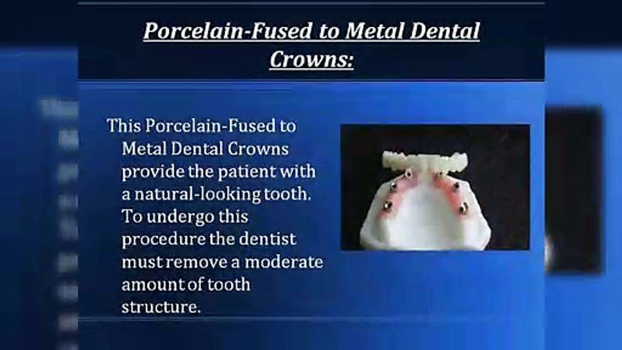 Dental Crown - Sacramento, CA