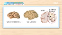 [HEALTHY] What are the causes of dreaded diseases, dementia?,기분 좋은 날20190118