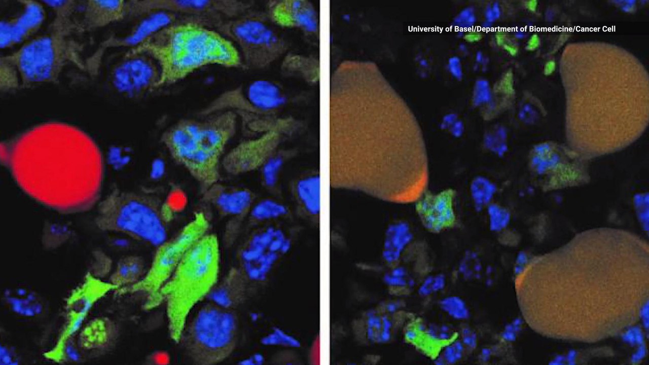 Researchers Trick Breast Cancer into Becoming Harmless Fat Cells