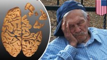 Kualitas tidur yang buruk berkaitan dengan Alzheimer - TomoNews