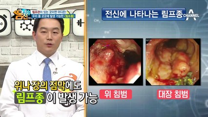 림프종은 목에만 생긴다? 'NO!!' 온 몸에서 발생하는 최악의 암, 림프종!!