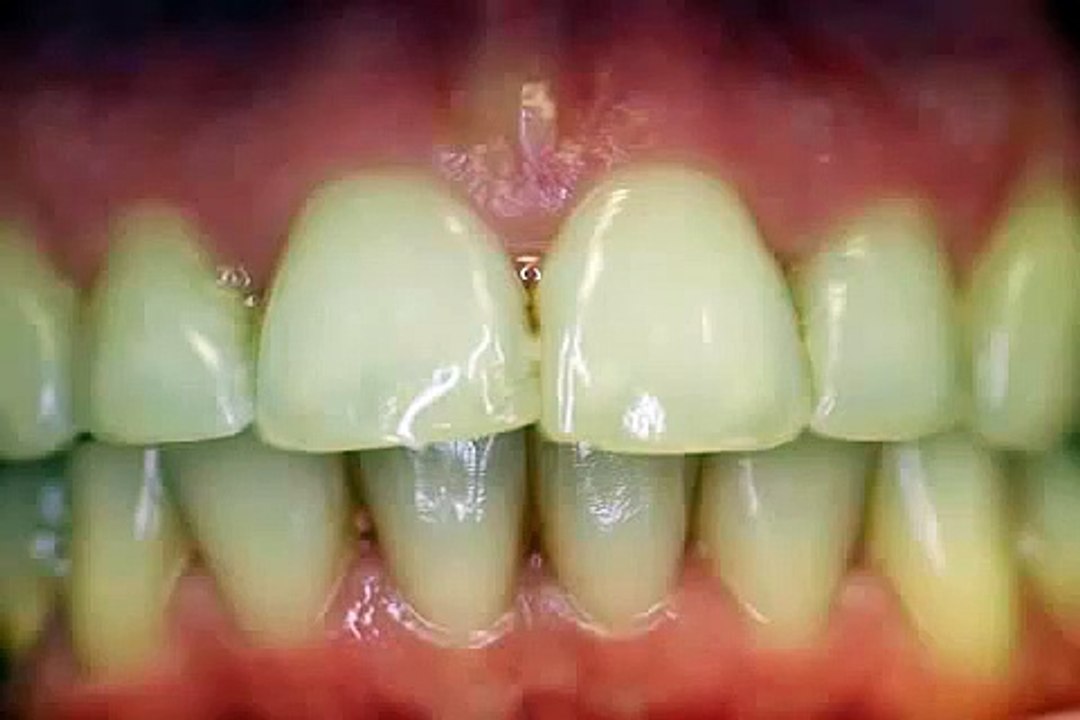worauf sollte man bei Zahnkronen achten