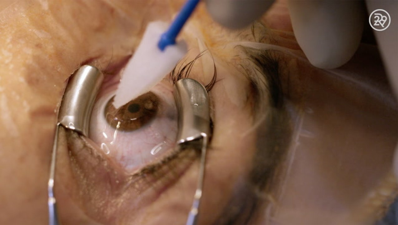What It's Really Like Getting Lasik Eye Surgery