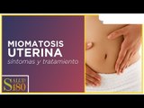 Miomatosis uterina y opciones de tratamiento Parte 1 | Salud180