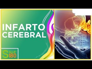 ¿Qué es el infarto cerebral? | Salud180