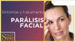 Síntomas de parálisis facial | Salud180