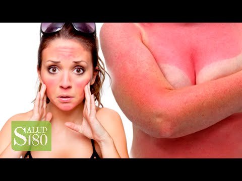 REMEDIOS CASEROS contra las QUEMADURAS | Salud180