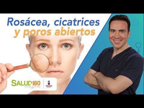 Dr. Salud | Rosácea, cicatrices y poros abiertos | Salud180