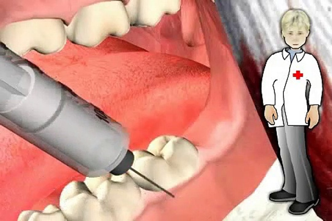 wann sollte ein Weisheitszahn entfernt werden, welche Risiken gibt es