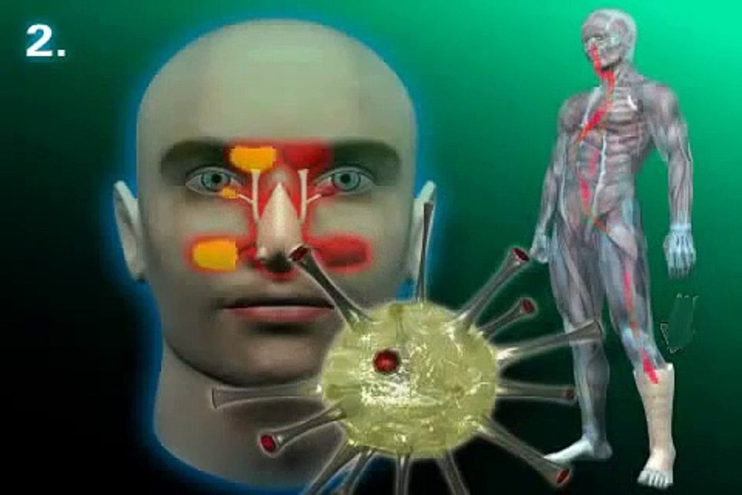 wieso können Zähne eine Sinusitis - Nasennebenhöhlenentzündung - auslösen