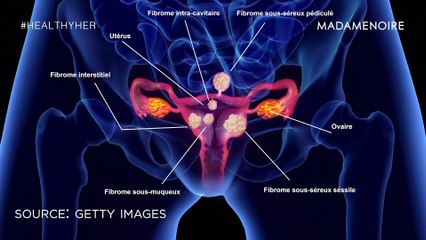 Everything Black Women Need To Know About Fibriods From A Black Doctor | Healthy Her
