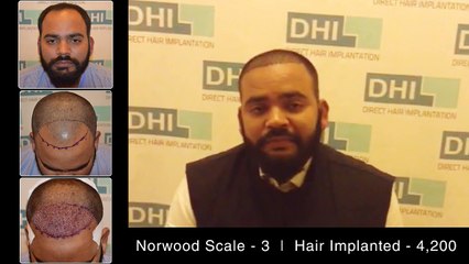 This is Why DHI is Global Leader in Hair Restoration| Happy Patient Testimonial - Must Watch