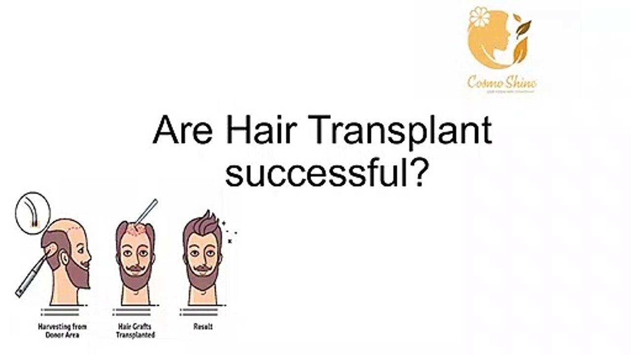 Are Hair Transplant Is successful