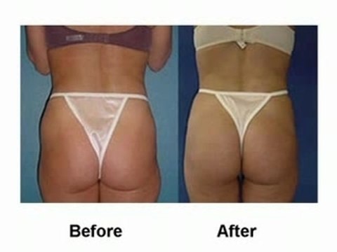 Liposuction Dallas Surgeons Before After