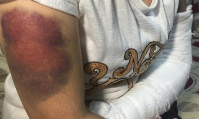 Kocası inşaat demiriyle işkence etti