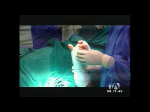 El injerto de piel es una cirugía plástica que ayuda a regenerar una quemadura