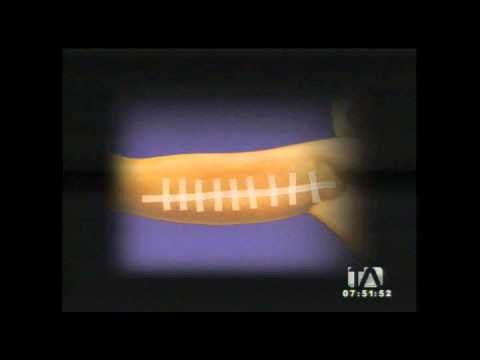 ¿Conoce la braquioplastía o lifting de brazos?