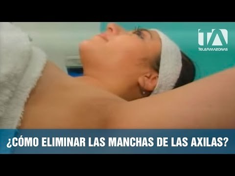 ¿Cómo eliminar las manchas de las axilas?