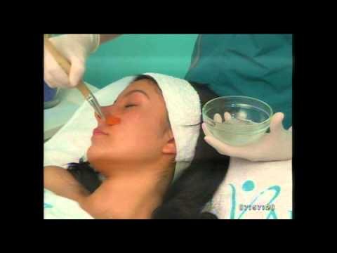 Trucos caseros para eliminar el enrojecimiento de las mejillas y la nariz