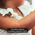 DOH declares measles outbreak in Metro Manila