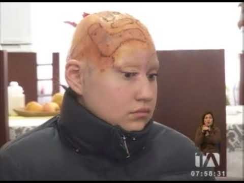 Laura perdió todo su cuero cabelludo durante practicas preprofesionales