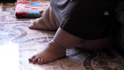 Fil hastalığına yakalanan Filistinli tedavi olacağı günü bekliyor - GAZZE