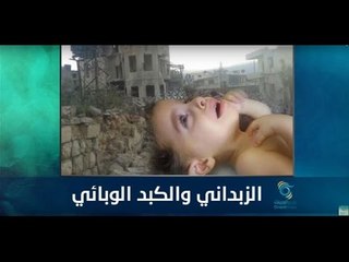 الزبداني والكبد الوبائي | رمانا الهوى