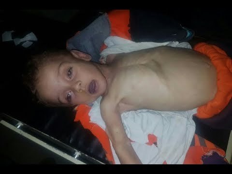 وفاة طفل ثالث بالغوطة الشرقية بسسب نقص الغذاء والدواء