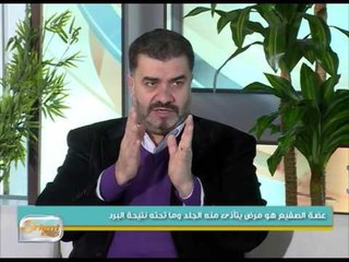 أسباب الأصابة بمرض عضة الصقيع وطرق العلاج منه | جولة الصباح