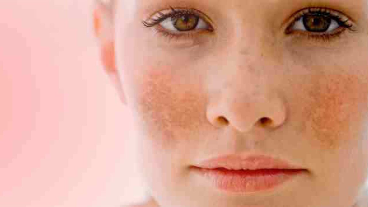 Home remedies for Melasma: मेलाज्मा दागों को हटाने के लिए अपनाएँ ये उपाय | Boldsky