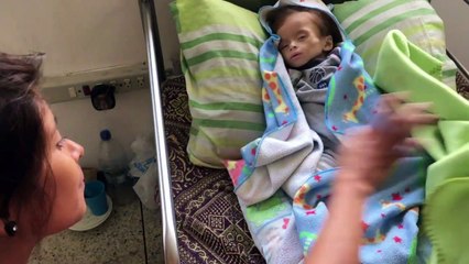 Niños desnutridos, un rostro desgarrador de la crisis venezolana