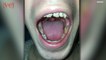 Man Claims Drinking 6 Energy Drinks A Day Ruined His Teeth