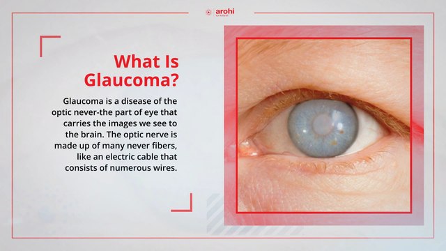 Glaucoma Specialist in Andheri West Mumbai - Arohi Eye Hospital