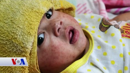 Amerika'daki Kızamık Salgını Yetkilileri Endişelendiriyor