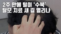 [자막뉴스] 2주 만에 털이 '수북'...탈모 치료 새 길 열리나 / YTN