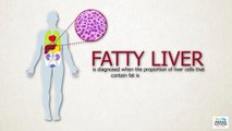 #पारसअस्पताल -Fatty Liver : Symptoms, Causes and Precautions | Paras Hospitals
