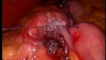 Gastric bypass