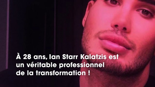 Un homme est tellement métamorphosé par la chirurgie esthétique que son ex le drague à nouveau sans le reconnaître