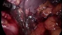 Laparoscopic Nissen