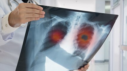Easy Ways to Reduce Your Risk of Getting Cancer