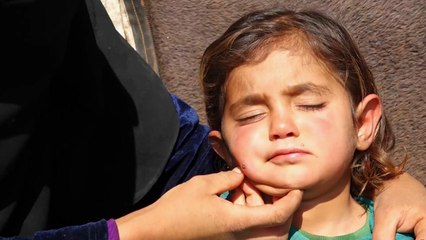 التلوث يفاقم مرض اللشمانيا بمخيمات تل الكرامة