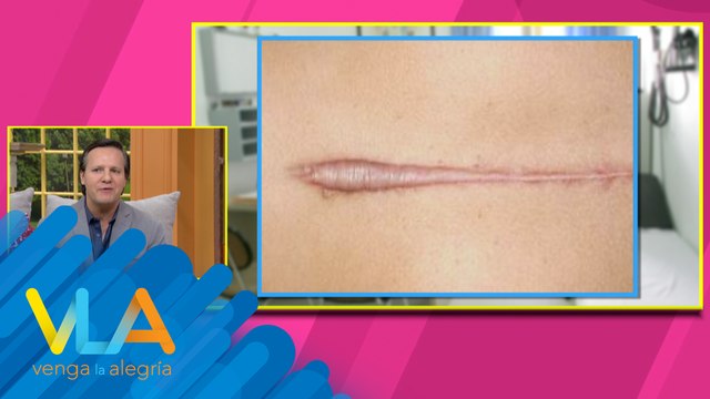 ¿Cómo podemos borrar las cicatrices queloides? El Dr. Krasovsky nos explica y resuelve los mitos al rededor de estas marcas en la piel.