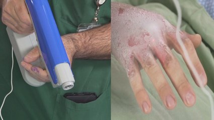 This Spray-On ‘Skin’ Can Treat Burns Quickly And Without Pain