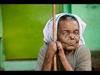 Contrary to govt claims, leprosy on rise in India - NewsX